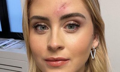 Valentina Ferragni dopo l'operazione