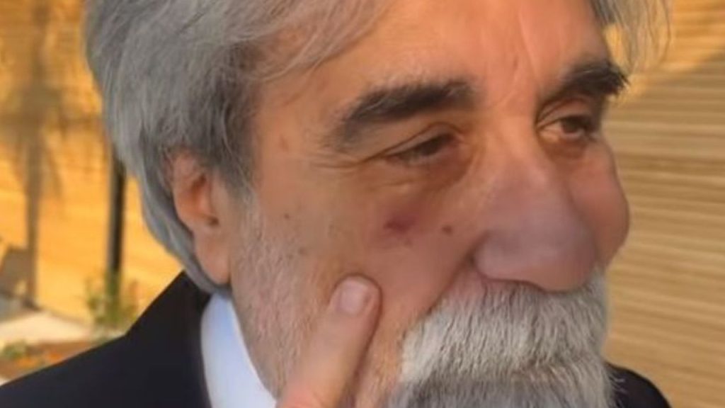 beppe vessicchio occhio nero sanremo